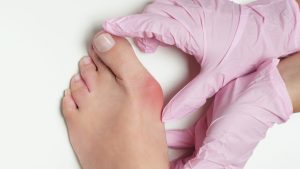 Hallux valgus